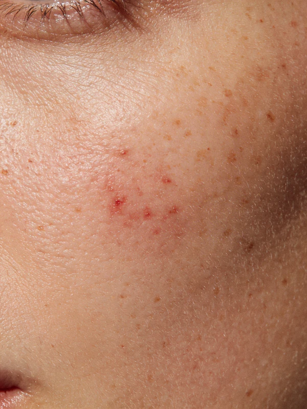 Close-Up of Cheek