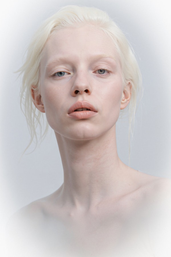 Portrait of an albino woman