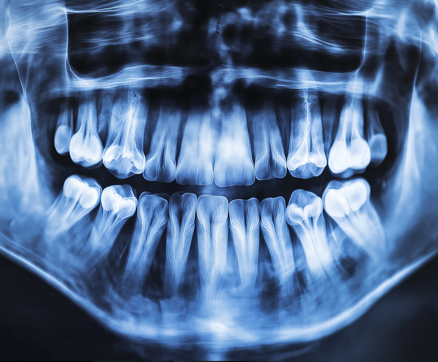 Panoramic Dental X-Ray